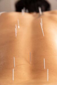 Acupuncture needles on back